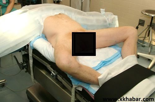 زراعة عضو ذكري لشاب لبناني في سابقة طبية
