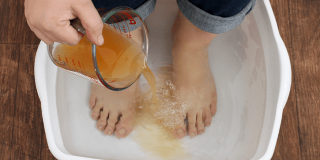 وضع القدمين في خل التفاح Feet in Apple vinegar