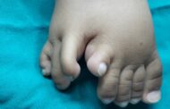 بالصور عملية نادرة لرضيعة مصرية بثلاث أقدام