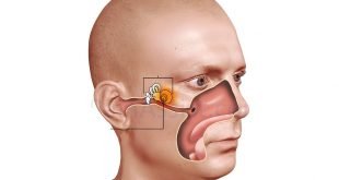 طرق علاج التهاب الأذن الوسطى المسبب الأول للدوخة